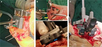 An early clinical comparative study on total knee arthroplasty with kinematic alignment using specific instruments versus mechanical alignment in varus knees